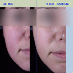 BIA Facial Oil for Dry, Sensitive & Eczema-Prone Skin