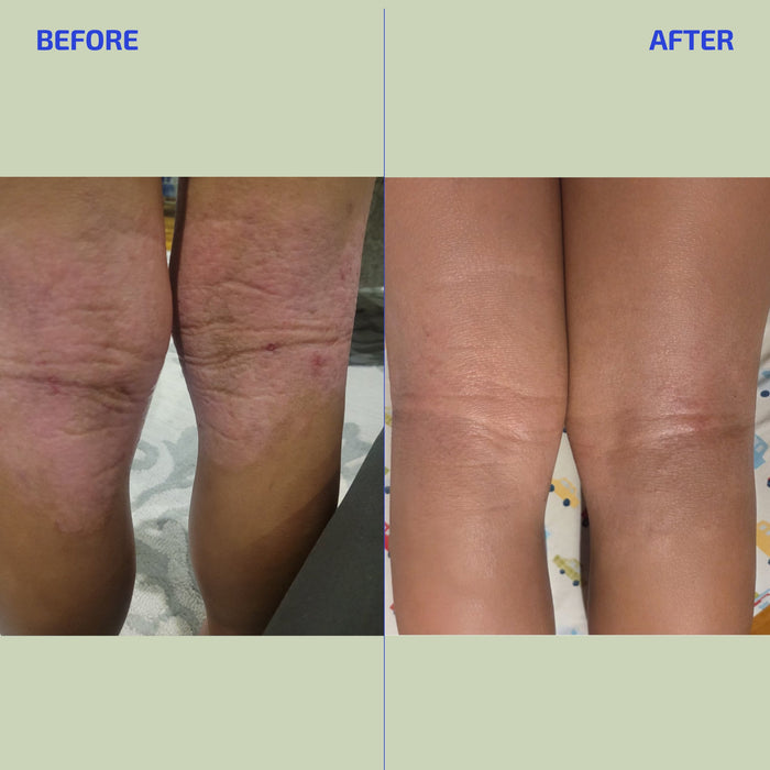 Before and after using colloidal lotion comparison of a person's legs showing skin improvement.