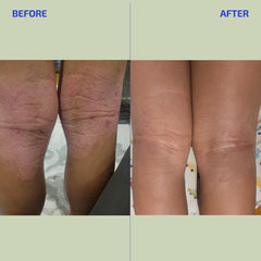Before and after using colloidal lotion comparison of a person's legs showing skin improvement.