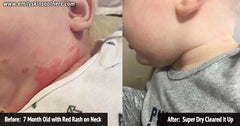 Emily Super Dry Soother for Thick, Dry Eczema